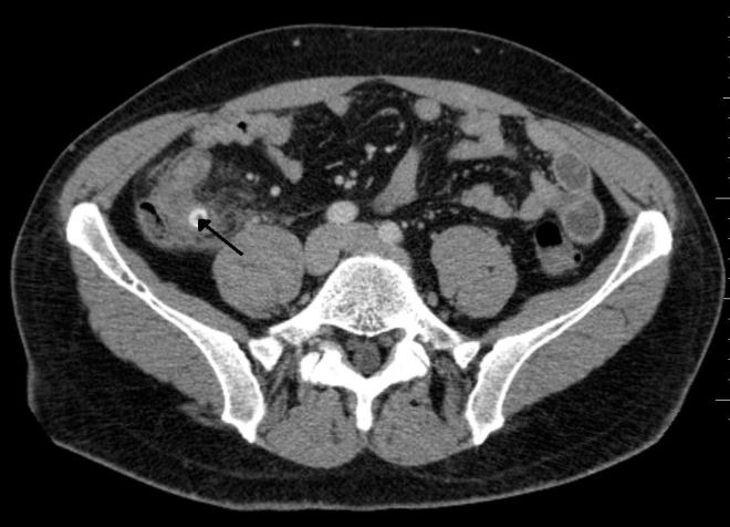 A fecalith which has resulted in acute appendicitis - James Heilman, MD - Doc James - Wikimedia Commons